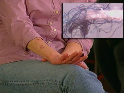 Morgellons Disease and mystery fibers